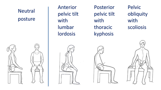 Figure 2: Common postural presentations.  Original image used with permission from Zollar, J.A. . Adapted by Turnbull, C. 2016.