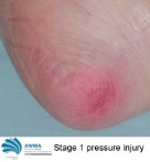 Stage pressure injury on heel