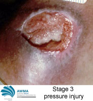 stage 3 pressure injury full skin thickness loss