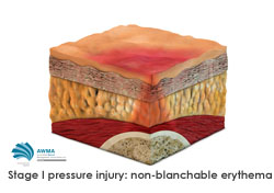 Stage 1 pressure injury: non-blanchable erythema