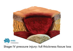 Stage 4 pressure injury full thickness tissue loss