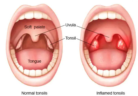 how to get rid of white spots on tonsils