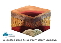 Suspected deep tissue injury depth unknown diagram