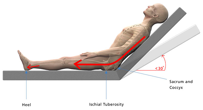 Supine with too much bed head raise