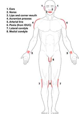 Common pressure injury locations, front