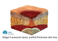 Stage 2 pressure injury partial thickness skin loss 