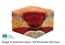 Stage 3 pressure injury full thickness skin loss